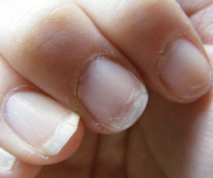 Les ongles révèlent la santé d'un individu